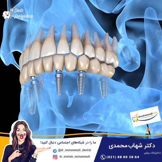 چه عواملی باعث عدم موفقیت کاشت ایمپلنت می شود؟ - کلینیک دندانپزشکی دکتر شهاب محمدی